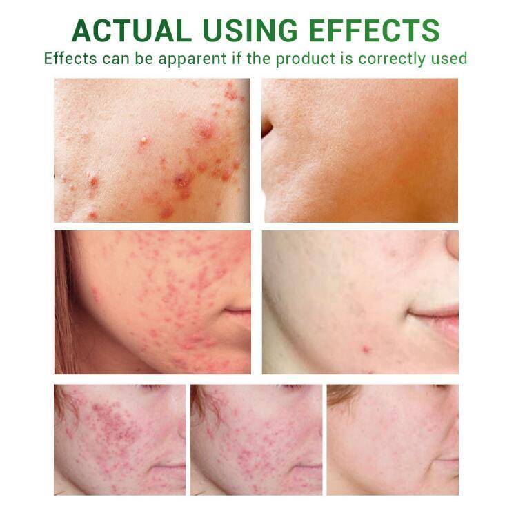 LUMIS | Anti-Acne Treatment Serum (Facial Repair + Oil-Free)
